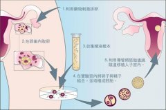做泰国试管婴儿的流程是怎么样的?