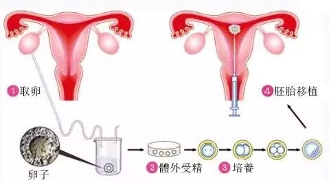 人工授精和试管婴儿有什么区别?
