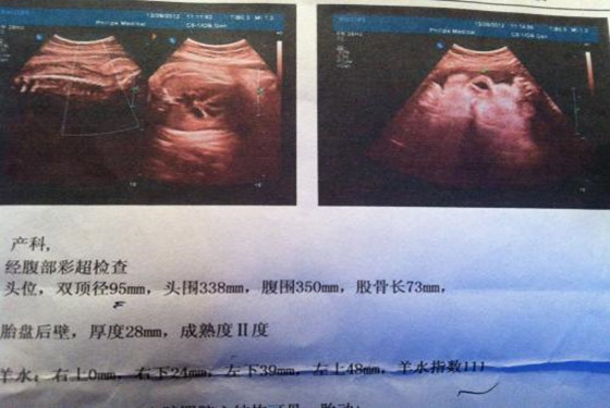 六个月胎儿彩超看男女 怀孕六个月男女区别图 
