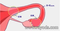 输卵管堵塞也许是女人这几个行为造成的，一定要小心