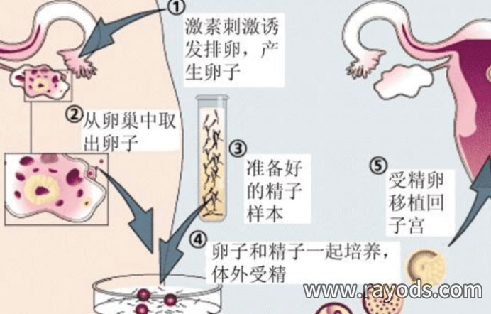人工受孕价格需要多少
