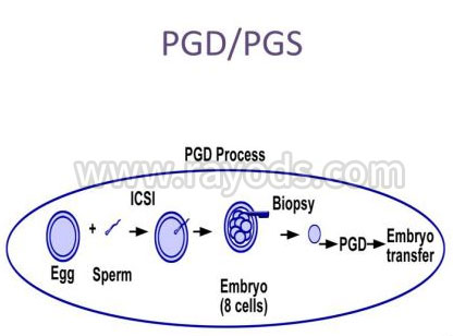 第三代试管婴儿PGD与PGS是什么
