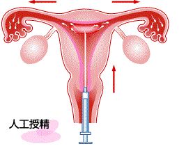 泰国做人工授精多少钱?3个因素决定你的费用