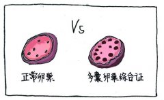 多囊卵巢综合症中药治疗方法
