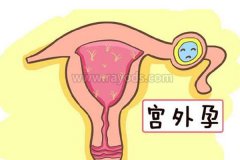 宫外孕复发率高？试管婴儿这样做可以有效避免
