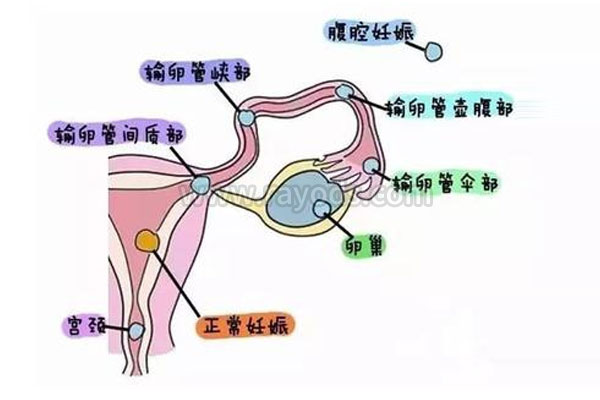 宫外孕复发率高？试管婴儿这样做可以有效避免