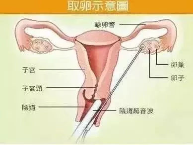 买卵子多少钱一颗，地下卵子交易的面试