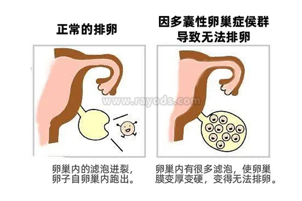 多囊患者如何提高试管婴儿成功率