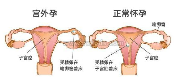 试管婴儿出现宫外孕的几种情况