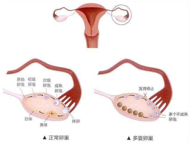 试管婴儿取卵后要怎样做才能保护卵巢健康