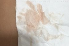 受精卵着床出血是为什么?1张图认识受精卵着床出血