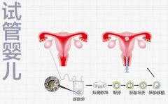 试管婴儿一代二代三代四代有什么区别