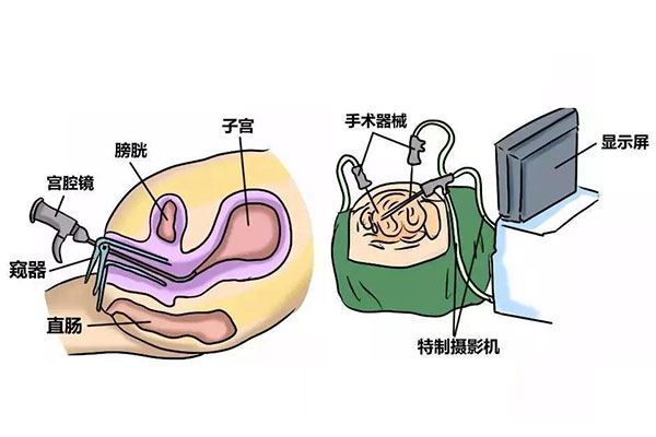 宫腔镜检查步骤图片