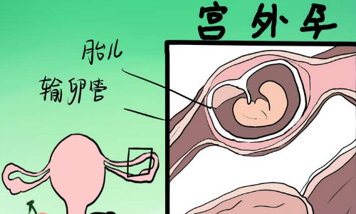 宫外孕留输卵管也废了吗