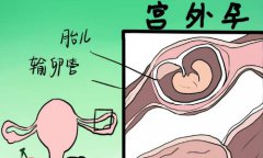 宫外孕治疗留输卵管也废了吗