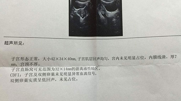 盆腔积液检查报告