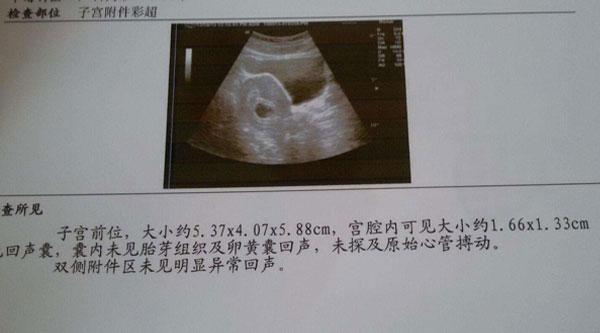 胎停育如何初步判断