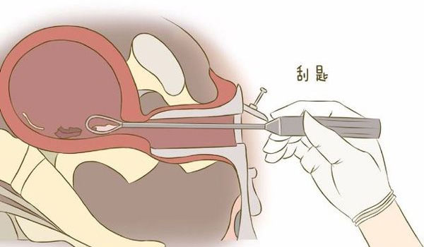 清宫手术过程图解