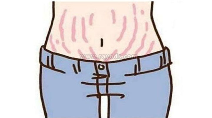 妊娠纹