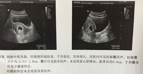 孕囊b超图片