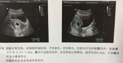 孕囊看男女准确率