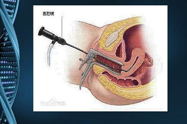 做试管婴儿前要做宫腔镜检查吗