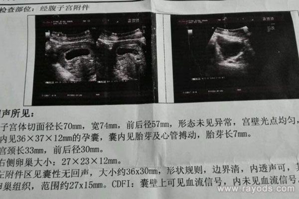 生男孩的孕囊是什么样子的