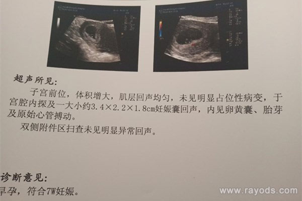 其实看孕囊很准 四十天孕囊圆形百分百女孩