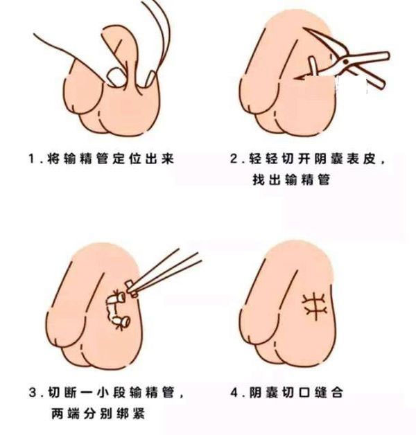 男性结扎手术