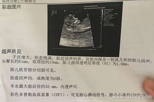 nt胎心率169生了个男孩 胎心看男女满足这条件才准