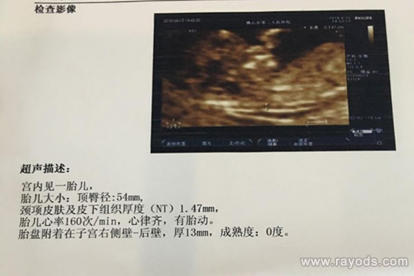 nt胎心率169生了个男孩 胎心看男女满足这条件才准