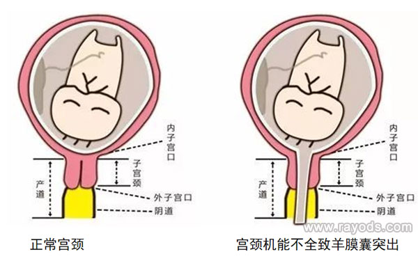 宫颈机能不全