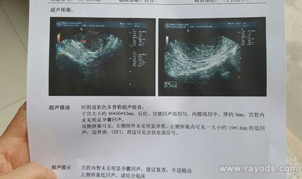 B超下孕囊图片