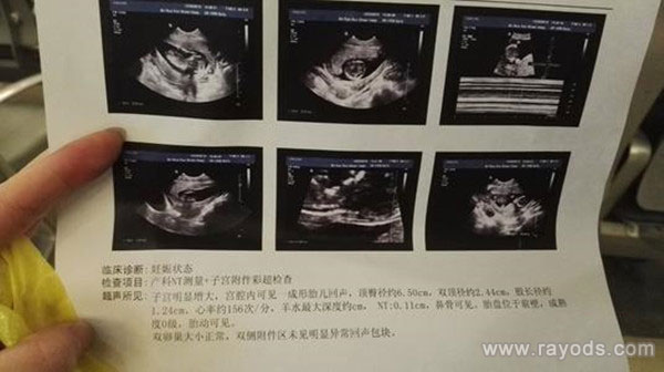 孕检nt胎儿不配合怎么办 妈妈给的建议一试就见效
