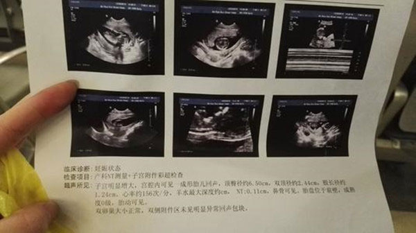nt值看孩子以后智商 nt值越低孩子越聪明的真相