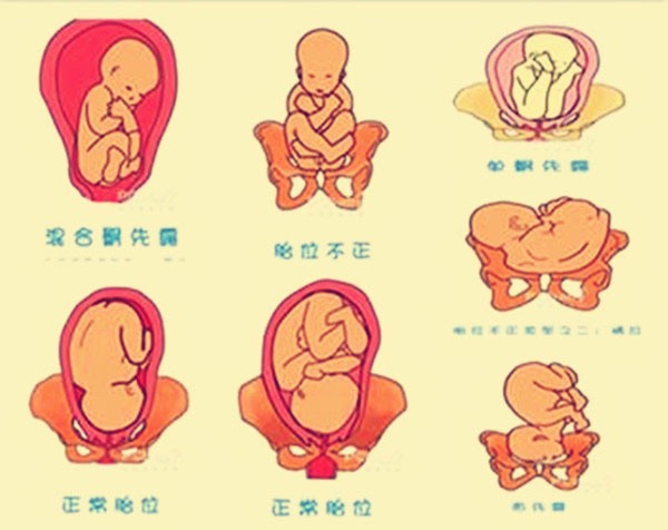胎位臀位是睡太多的原因吗 胎儿臀位如何纠正能否顺产