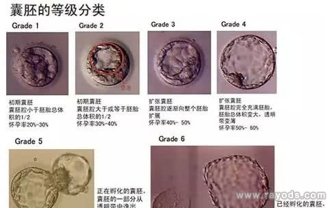 第五天（D5）囊胚质量评级