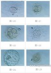 试管婴儿胚胎移植具体过程及方式
