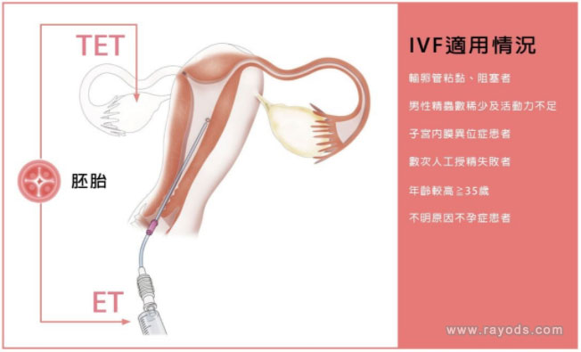 试管婴儿流程介绍