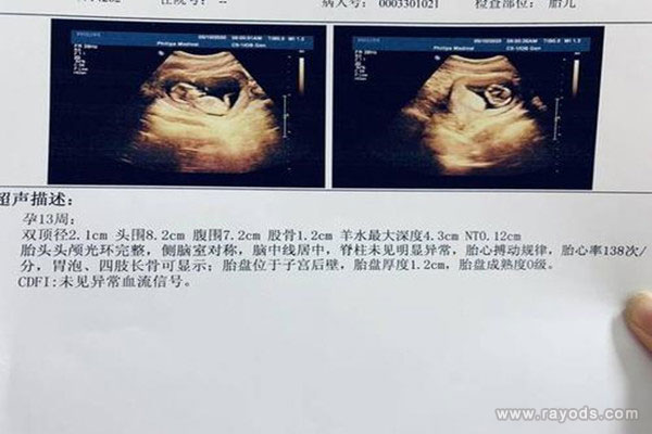 B超三条白线是女孩 NT三个亮点是男孩女孩