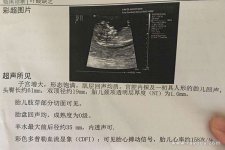 nt值0.8mm男孩还是女孩 过来人验证nt值结果