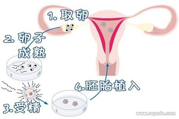 人工受精