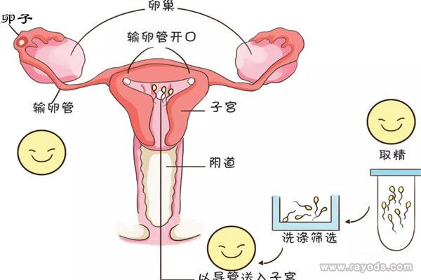 人工授精