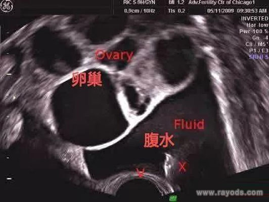腹水图