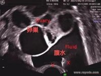 取卵后腹水如何消除,记住这6点,预防取卵后腹水