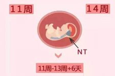 nt检查最佳检查时间在孕几周？nt检查最佳时间怎么计算