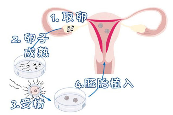 试管婴儿步骤
