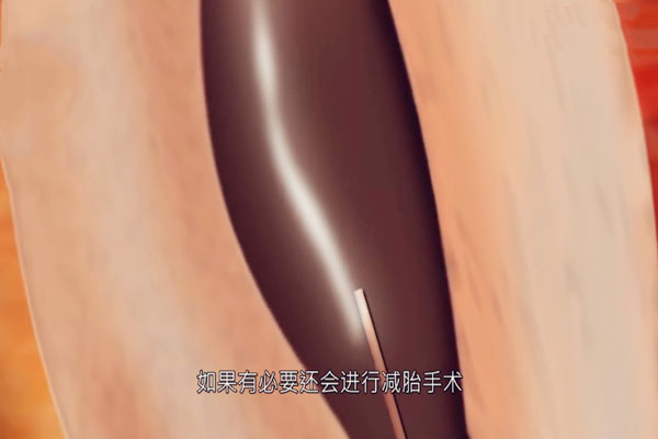 3D模拟图告诉你做试管婴儿疼吗