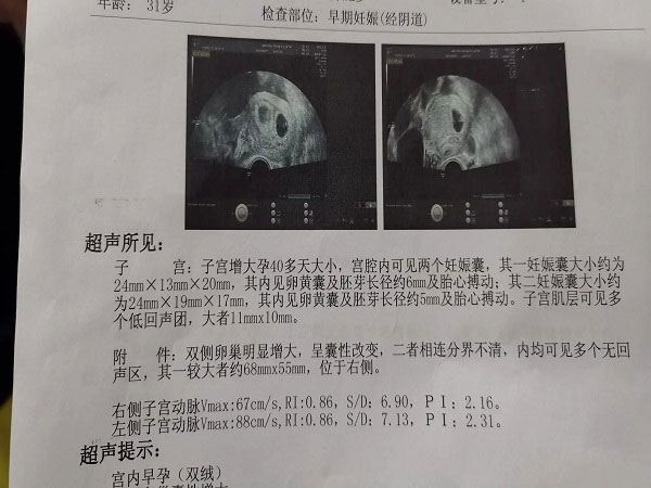 试管双胎的条件