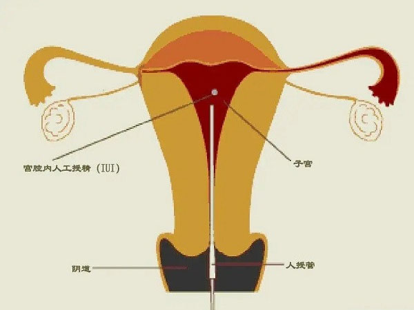 人工授精